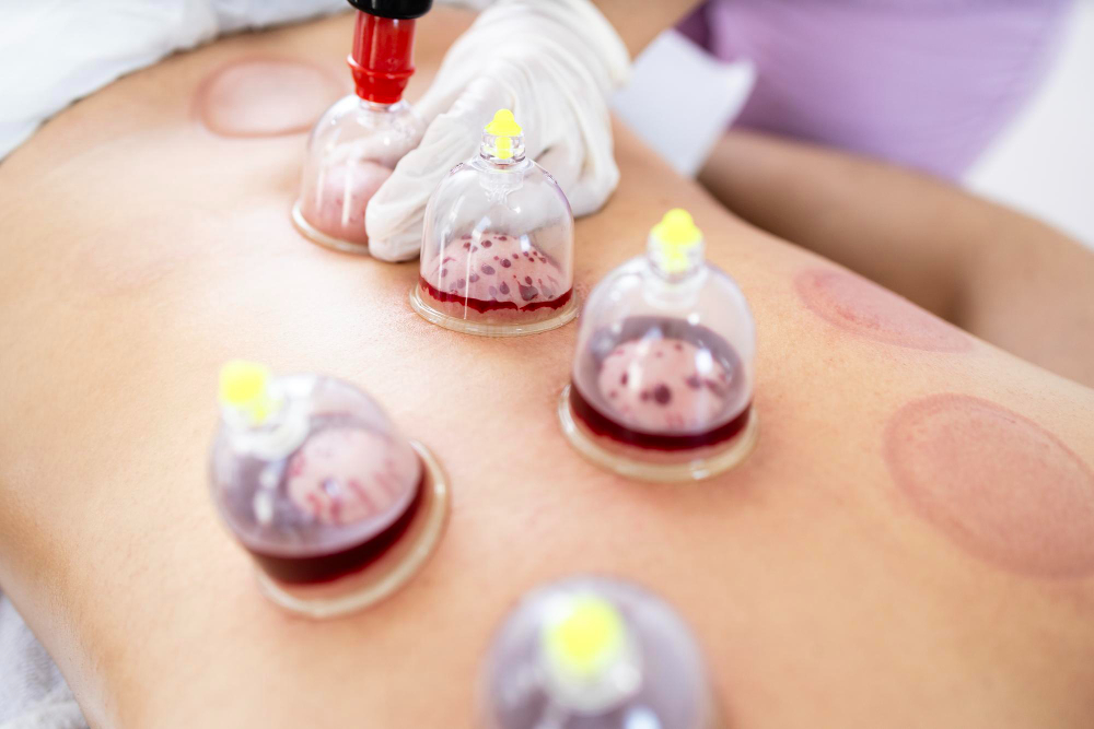 Hijama Therapy